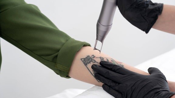 Ein ungewolltes Tattoo wird mit dem Laser entfernt.